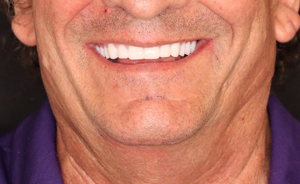 Patient after full-arch dental implant treatment at Innate Dental Solutions, Plano TX — case 1