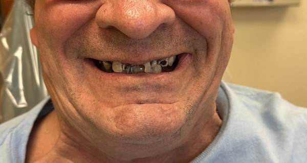 Patient before full-arch dental implant treatment at Innate Dental Solutions, Plano TX — case 1