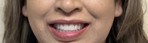 Patient after full-arch dental implant treatment at Innate Dental Solutions, Plano TX — case 2