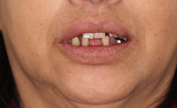 Patient before full-arch dental implant treatment at Innate Dental Solutions, Plano TX — case 2