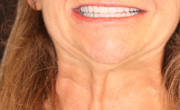 Patient after full-arch dental implant treatment at Innate Dental Solutions, Plano TX — case 3