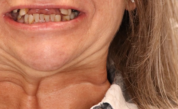 Patient before full-arch dental implant treatment at Innate Dental Solutions, Plano TX — case 3