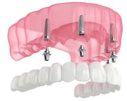 All-on-X fixed full-arch dental implants — Plano TX