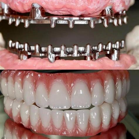 Dental implant treatment at Innate Dental Solutions, Plano TX