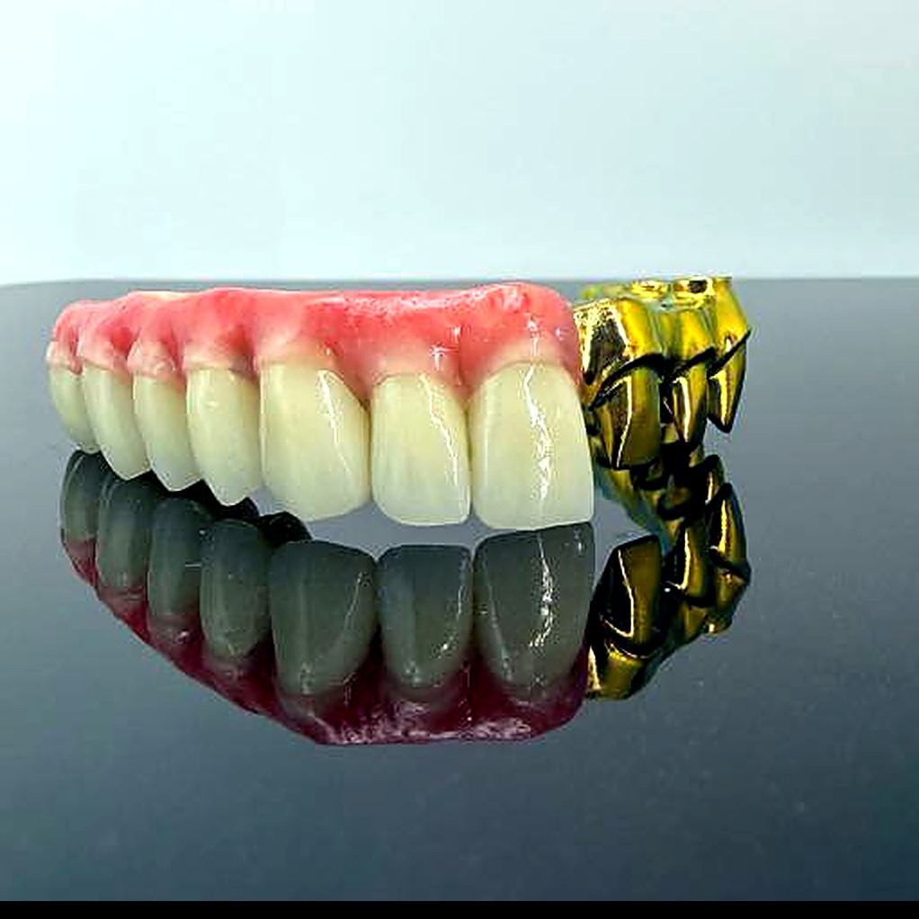 Malo-style full-arch bridge with gold-anodized titanium framework