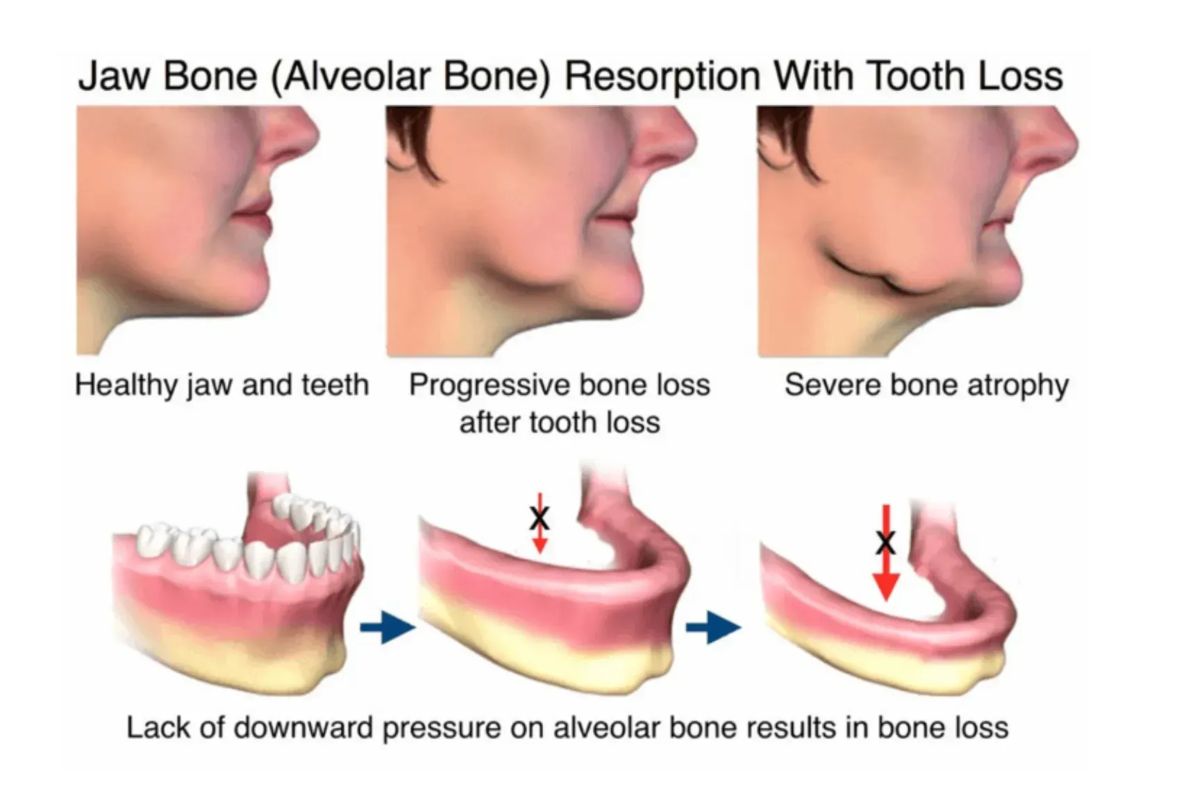 Illustration of jawbone loss caused by missing teeth — prevented with dental implants